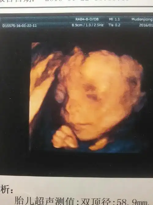 四维宝宝右面的眼睛怎么鼓鼓的,当时没注意,没有问医生回家才看到.