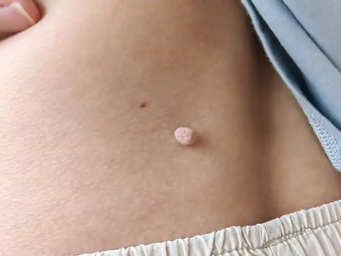 头上和腰背部的肉疙瘩,一样吗?