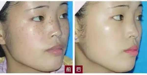 彻底去痘,到屯留皮肤专科诊所,安全健康,放心更贴心哦.