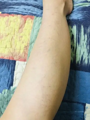 在家跑步机隔天跑一次快1年了,小腿上的红血丝慢慢变多,和跑步有关系