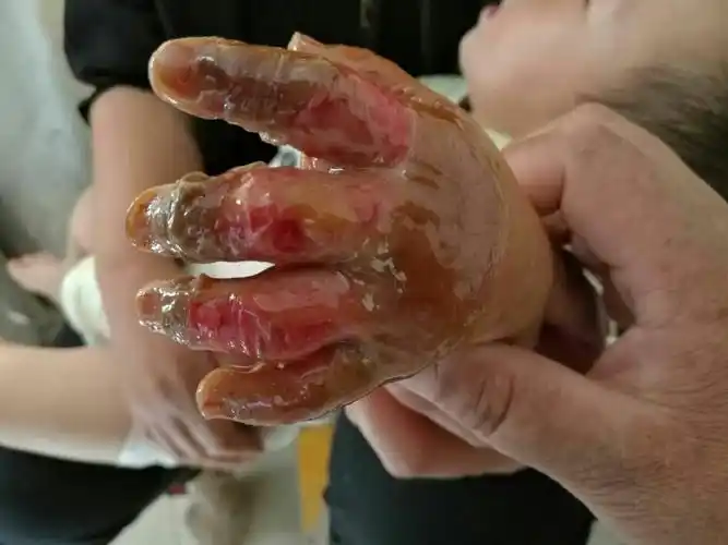 儿童烫伤紧急处理与预防