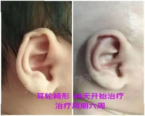 耳轮畸形新生儿耳廓形态畸形的最佳无创矫正治疗期为出生后的7-21天