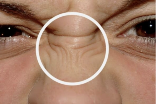 横纹,说明体内脂肪含量已经超标,很有可能是血脂过多引起的鼻梁中间有