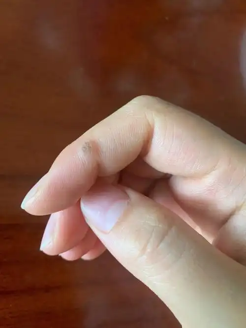 困扰了一年多的疣终于去掉了,我的手是丝状疣 寻常疣的一种,就是因为
