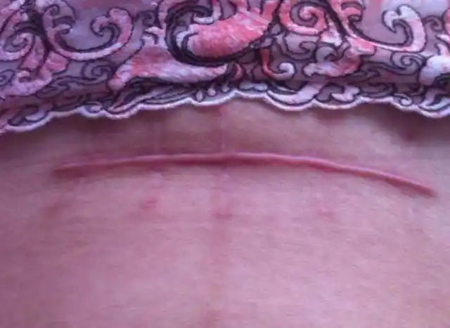 女人两次剖腹产后还能再生吗剖腹产可以生三胎吗第三