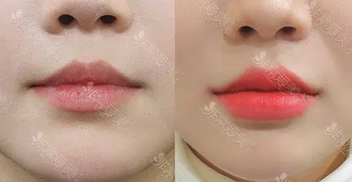 韩国哪家医院做嘴巴好嘟嘟唇效果谁的审美更在线