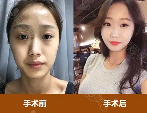 脂肪填充手术前后对比