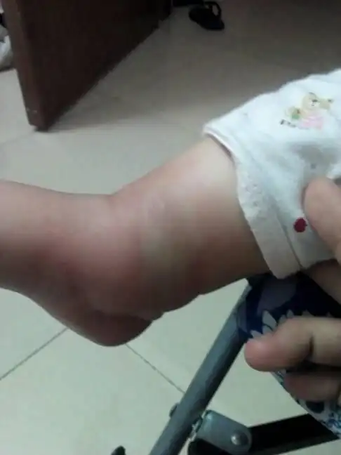 哪位知道什么虫子把宝宝脚咬成这样