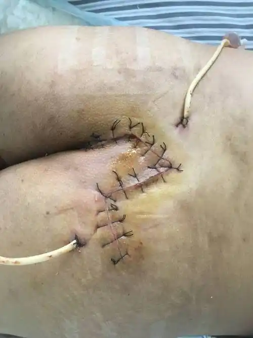 其它 一例藏毛囊肿切除limberg皮瓣转移术 写美篇同