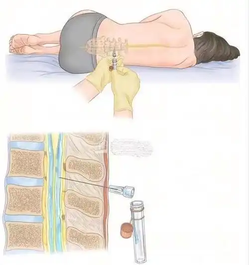 腰椎穿刺术 特色诊疗 -首都医科大学附属北京胸科医院