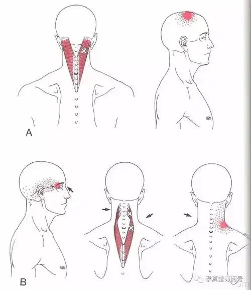头颈夹肌成精了