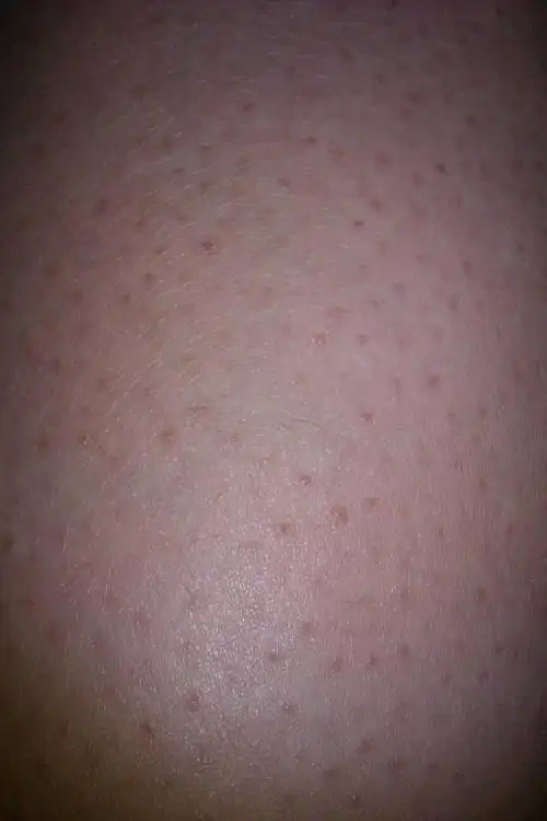 这个属于毛囊炎吗!要怎么消除?跪求好办法!