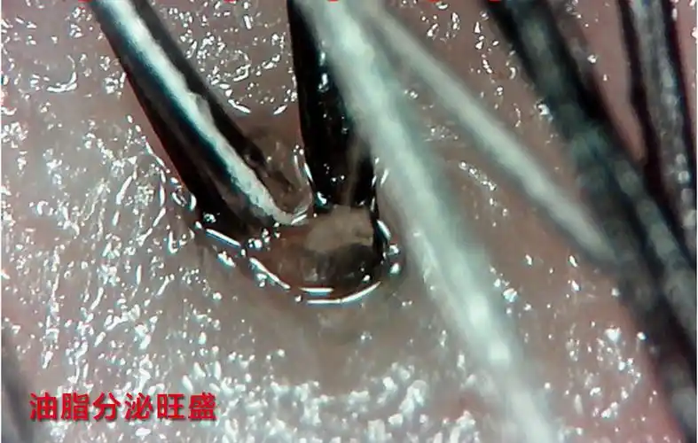 7种头皮问题治疗清单,望您收下!_毛囊