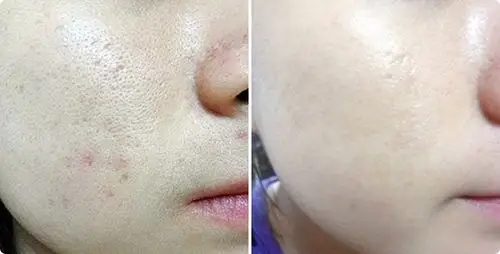 黄金焕肤前后对比图黄金焕肤效果图黄金焕肤前后对比照片