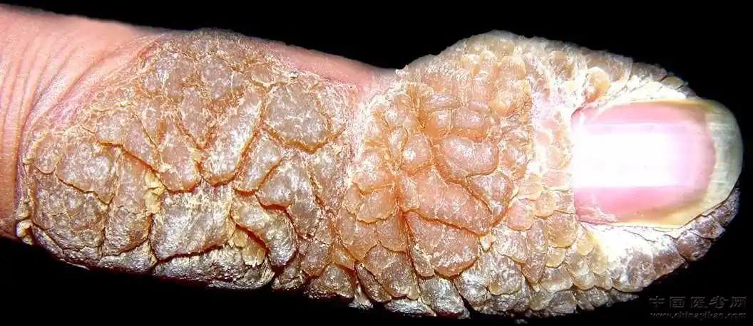 史上最全的皮肤病图谱来了(修订版)!