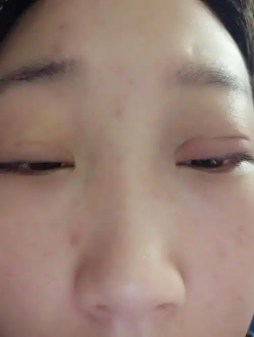 埋线双眼皮做完之后两个眼睛不对称,一个埋的特别深了,而且一看非常