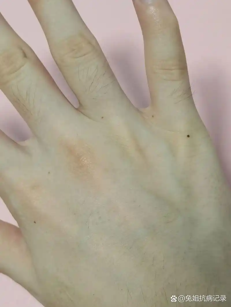 最近突然发现右手手背上长了五颗痣,救命,突然多了五颗,还是连串的,好