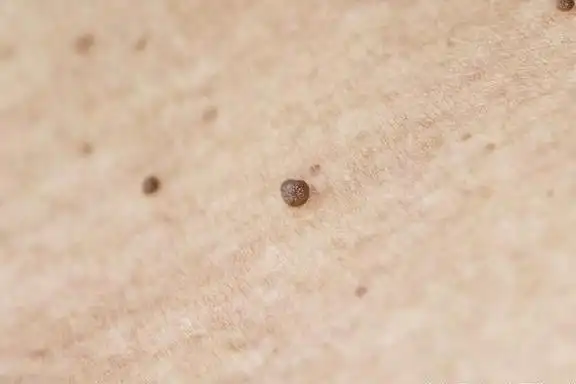 扁平疣都涨到脸上了怎么办日常生活中应该注意什么