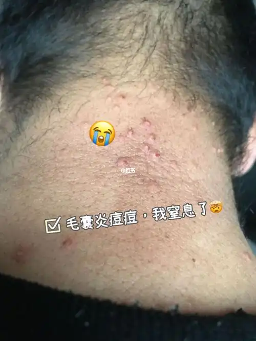 去年我毛囊/炎爆发的时候,头已经秃顶了,太难受了头皮上,随便摸一处都