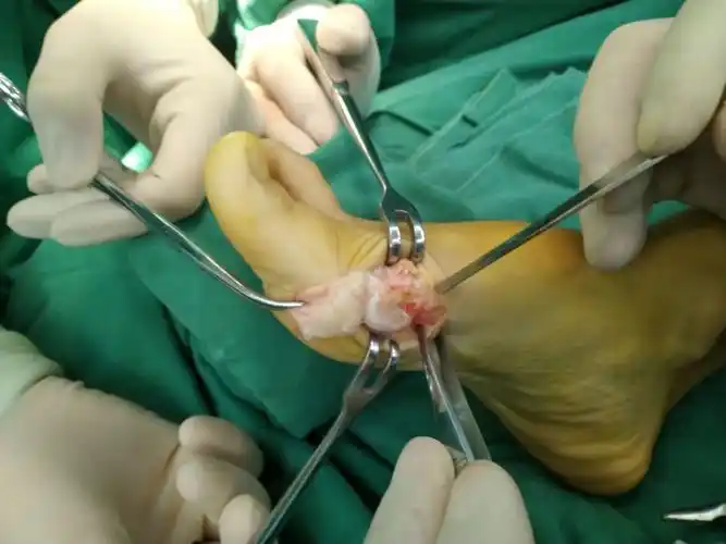 双足拇外翻chevron矫形术