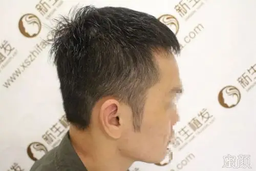 男士鬓角种植,术后男人味十足