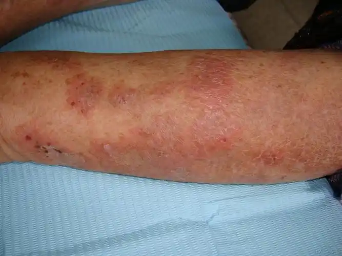 老年病人,反复一年 - 皮肤及性传播疾病讨论版 - 爱爱医医学论坛