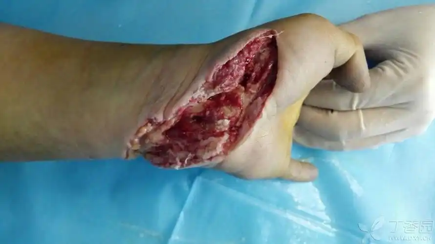 腕部切割伤 - 骨科专业讨论版 -丁香园论坛