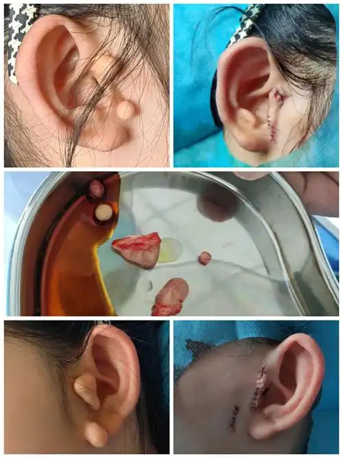 耳朵长了小赘肉咋办丨我院成功为一名先天性附耳小患儿进行了手术切除