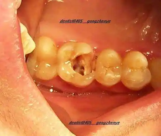 上颌第一磨牙在就诊时要注意