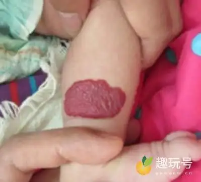 血痣和红痣的区别图片血管瘤与红痣的三大区别