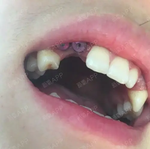 六颗种植牙两个月反馈