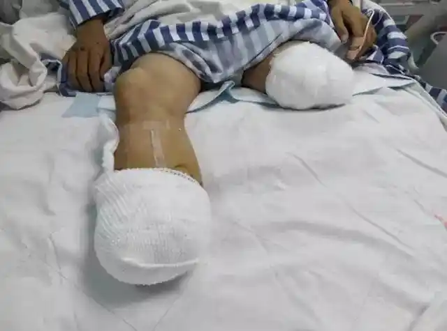 【接力】潮南车祸中的15岁学生再次做截肢,急需各方捐助!