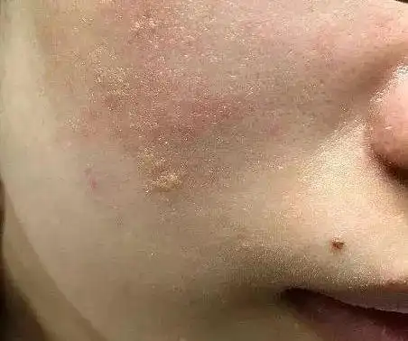 常见面部皮肤病 脂溢性皮炎