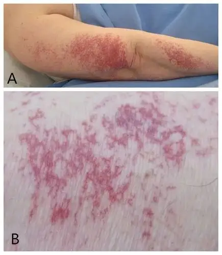 行医笔记:这种毛细血管扩张不单纯