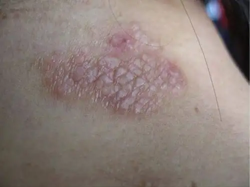 患神经性皮炎形成的危害是什么