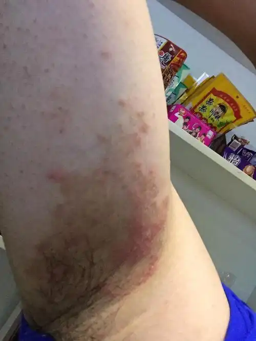 问:最近我腋下长了一些红疙瘩,很痒,怎么回事啊?