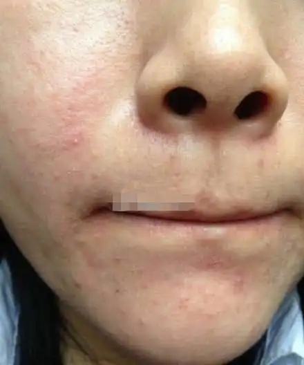 当脸上出现这几种情况,不要再用洗面奶了,你的皮肤屏障已经受损