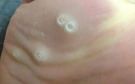 脚鸡眼治疗方法 这些基本的自治方法有效的缓解痛疼