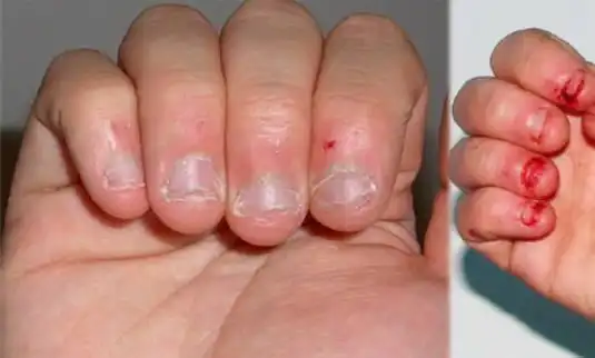 男子因咬指甲差点被截肢!孩子的这些小习惯要重视