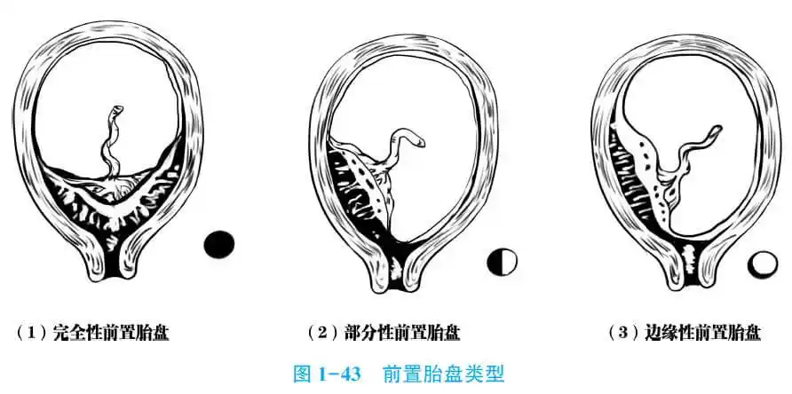 临床助理医师考试精华前置胎盘高危人群