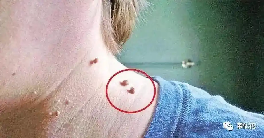 研修班第1144开课—中级课程《腺体疣》_症状