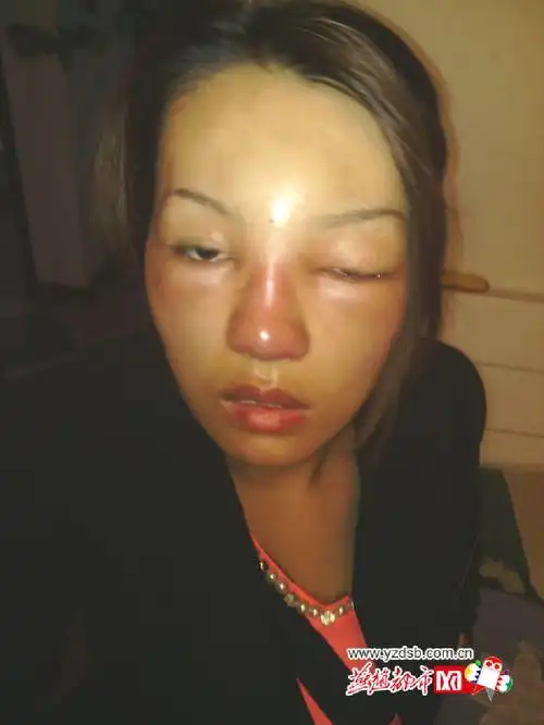 石市甜美女孩失恋后去整容几年后变得丑陋不堪