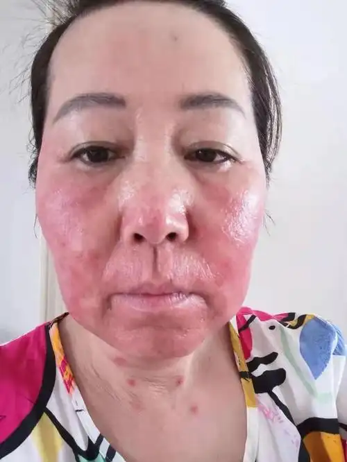 皮肤发红发烫是玫瑰痤疮吗?