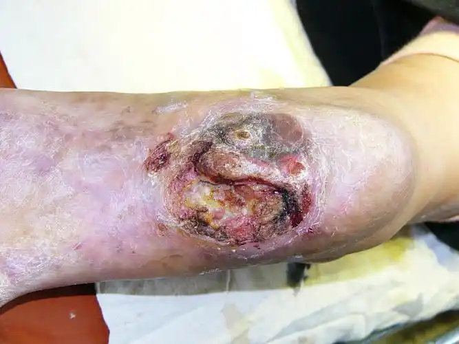 请大家讨论一下这样的皮肤缺损如何治疗?