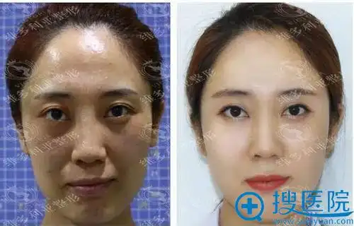 自体脂肪填充全脸前后对比图