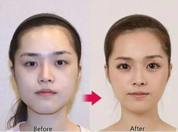 组图:震撼整容术 惊呆小伙伴