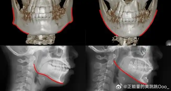 为什么下颌骨对我们的脸型基底影响大?