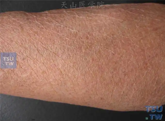 老年性皮肤萎缩atrophiacutissenilis症状表现