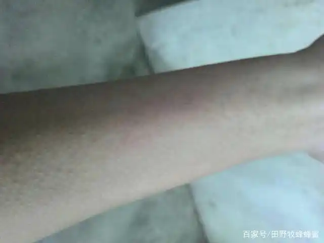 吃虾喝蜂蜜水全身痒,吃虾喝蜂蜜水会过敏吗?