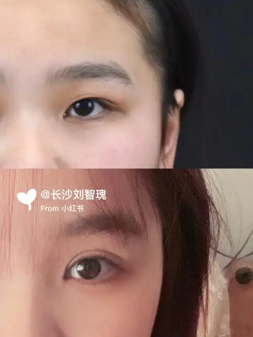 埋线和全切该如何选